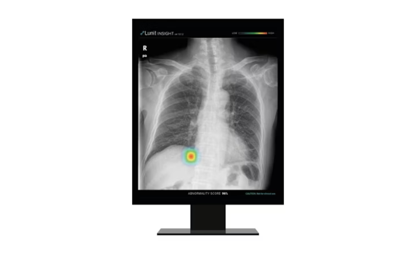 CXR LUNIT 